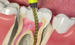 All About Root Canal Treatment In Delhi
