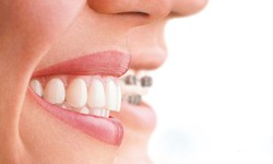 Aligners with invisible braces are best for adults