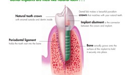 The Importance of Dental Bone Grafts: Restoring Oral Health and Function