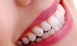 Enhancing Your Smile with Composite Bonding in North London