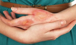 The Ultimate Guide to Burned Skin Treatment: Diagnosis and Effective Solutions