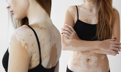 10 myths and facts around vitiligo you should know first