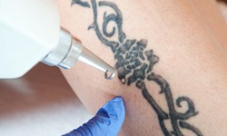 Things about laser tattoo removal