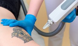 Laser tattoo removal post-treatment care