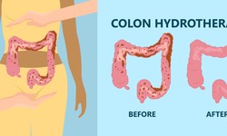 How Does Colon Hydrotherapy Work?
