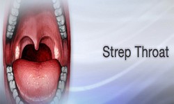 When Should You Seek Treatment for Strep Throat Without Tonsils?
