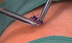 The Benefits of Home Suture Removal: A Comprehensive Guide