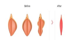 What Are The Vital Things To Know About The Vaginal Reconstruction Surgery