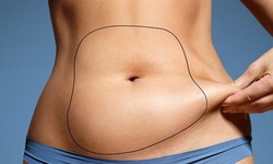 How to Maximize the Benefits of Liposuction Treatment