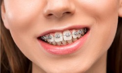 Unlocking Smiles: The Ultimate Guide to Lingual Braces