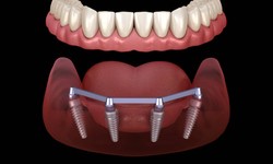 The Complete Guide to All-on-4 Dental Implants: Everything You Need to Know