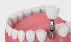 The Ultimate Guide to Dental Implants in Dundas