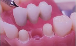 Comprehensive Guide To Dental Bridges: Restoring Your Smile