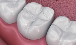 Enhancing Smiles Through Dental Filling Treatments