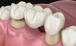 The Science Behind Dental Crowns: How They Restore Your Smile