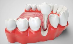 Maintaining Your Dental Implants: Oral Care Tips for Bradford Residents
