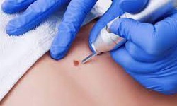 Why Is Skin Tag Removal Necessary in Dubai?