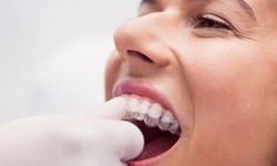 Advancements In The Technology Of Invisalign Treatment