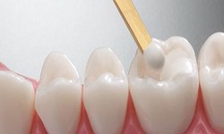 Teeth Filling Services: Restoring Your Smile with Care