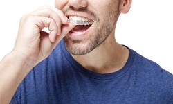 Invisalign In Windsor Ontario: Your Path To A Beautiful Smile