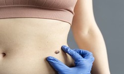 Lipoma Surgery in Pune: Finding the Right Specialist for Lipoma Removal