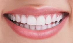 Teeth whitening kits vs. professional treatment in the UK