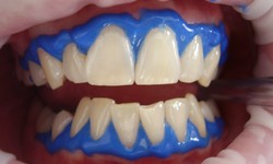 Demystifying the Top 5 Misconceptions Surrounding Teeth Whitening and Providing Insight into Frequently Asked Questions