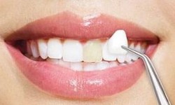 Dental Veneers Can Correct Dental Imperfections and Boost Your Confidence