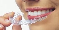 Learn Everything about Invisalign and what is the Cost of Invisalign?
