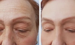 Botox in Oakville: A Non-Surgical Solution for Wrinkle Reduction