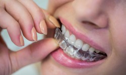Invisalign: the top 5 ways it can benefit you.