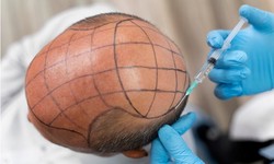 Exploring Hair Transplant Options in Istanbul, Turkey