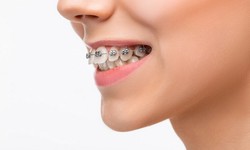 Brace Yourself for a Perfect Smile: Navigating Traditional Braces in Columbus, Ohio