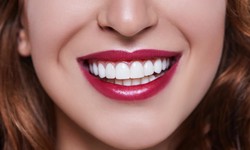 Unlock Your Perfect Smile with Porcelain Veneers in Rochdale