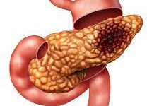 Hereditary Pancreatitis Disease: A Genetic Predisposition