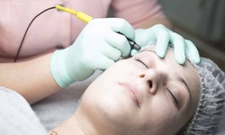 A Guide to Electrolysis Hair Removal in Cardiff: Unveiling Smooth and Lasting Results