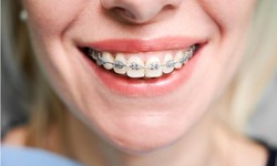 Behind the Scenes of Orthodontic Care: Lingual Braces Unveiled