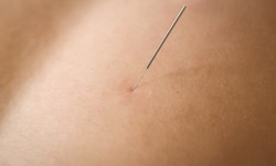 Finding a Qualified Dry Needling Practitioner in Brisbane