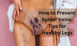 How to Prevent Spider Veins: Tips for Healthy Legs