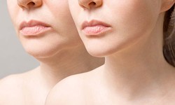 Experience the Wonders of Non-Surgical Rejuvenation with Dermal Fillers
