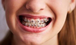 Straight Talk: The Ultimate Guide to Traditional Braces in Columbus