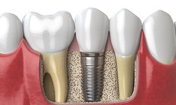 Things you must know about implant dentistry