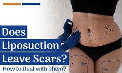 What You Should Know About Lipo 360 Scars
