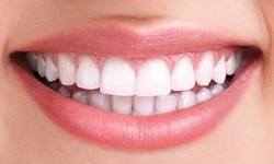 The True Review About Using Mysmile teeth Whitening Kit