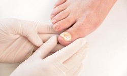 Is Ingrown Toenail Treatment Painful? Exploring the Discomfort and Relief