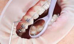 A Guide To Cleaning Teeth With Braces
