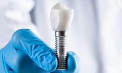 Reasons to Consider Professional Dental Implants for Single Tooth Replacement