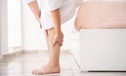 Deciphering Varicose Veins and How to Manage Them