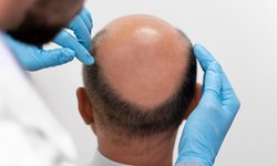 Exploring Hair Transplant Techniques: A Comprehensive Guide