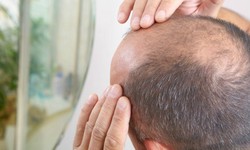 Discover the Magic of PRP Hair Restoration